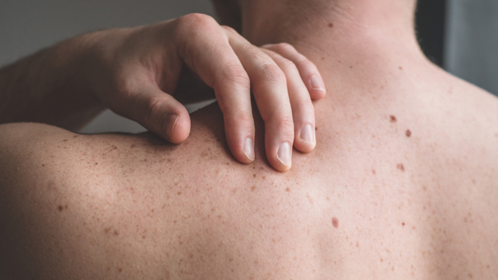 dajte si skontrolovať znamienka